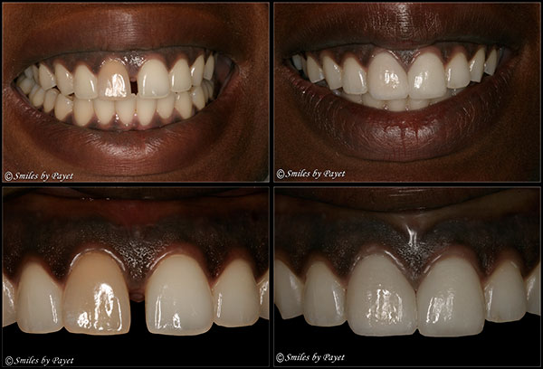 Pictures Of Before And After Veneers. IS THE CLOSED GAP AN